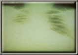 Image of chest x-ray