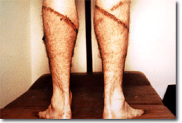 irritated skin on man's legs