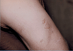 Figure 4.  Private Fisher blister injury - Dr.  DeClue photo